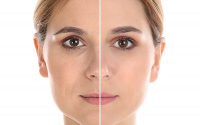 Lifting Facial: La Solución Más Efectiva para Rejuvenecer el Rostro y Recuperar la Firmeza