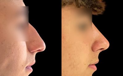 Cómo la rinoplastia ultrasónica está revolucionando la estética facial