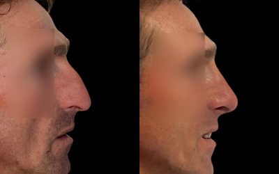 Rinoplastia ultrasónica: tecnología avanzada para una recuperación más rápida