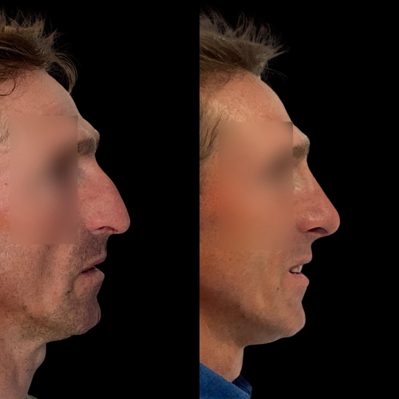 rinoplastia ultrasónica