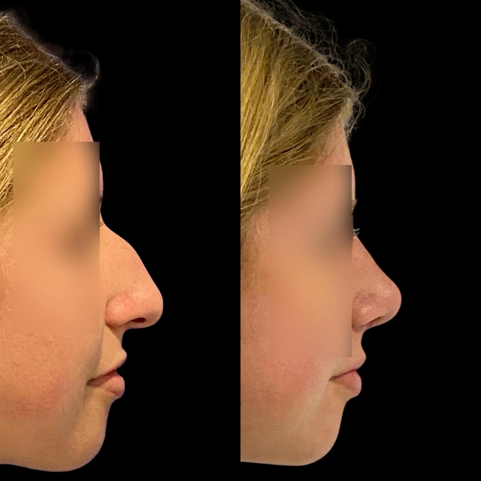 Rinoplastia ultrasónica en Málaga – cirugía estética de nariz de alta precisión