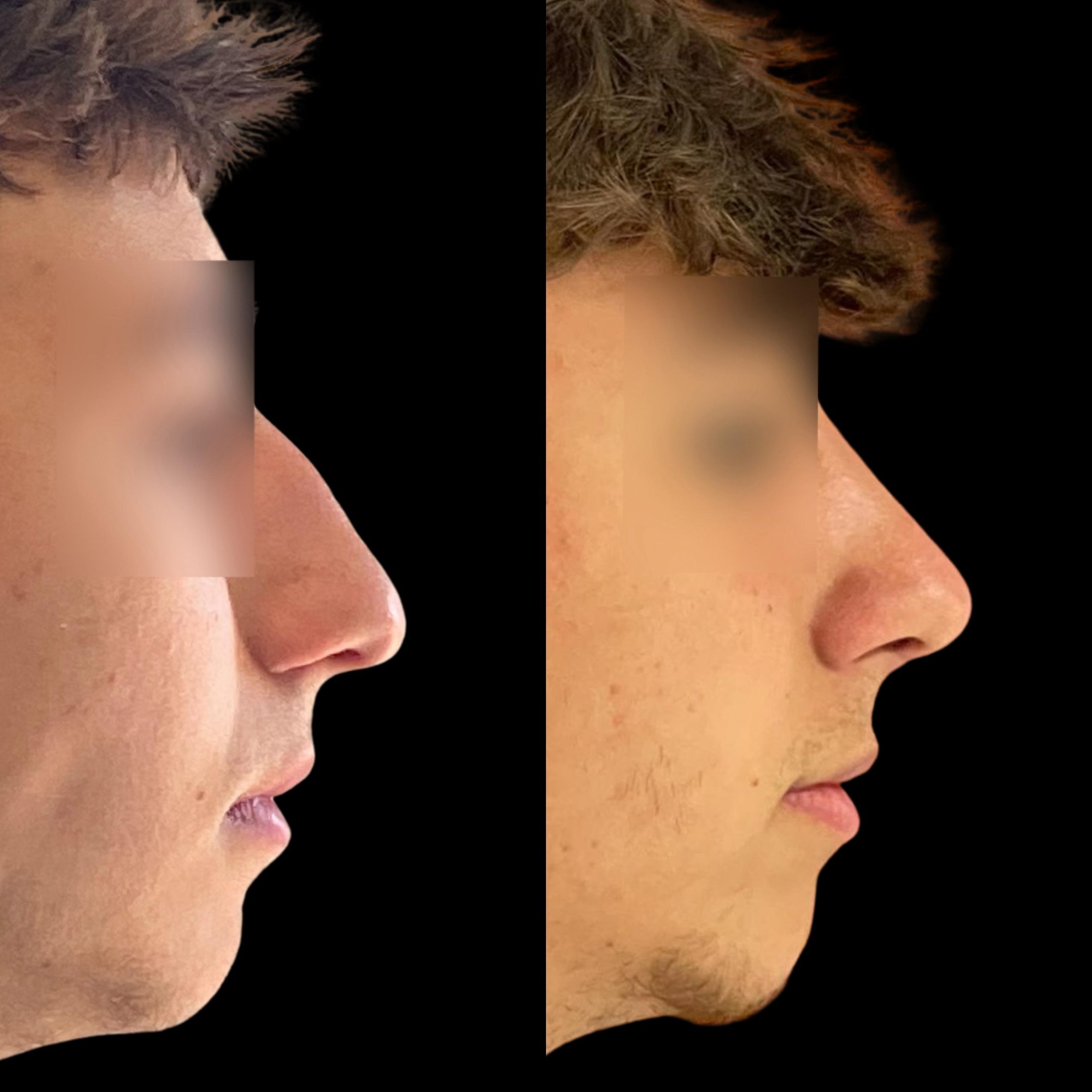 Rinoplastia en Málaga – Cirugía estética para mejorar la forma de la nariz