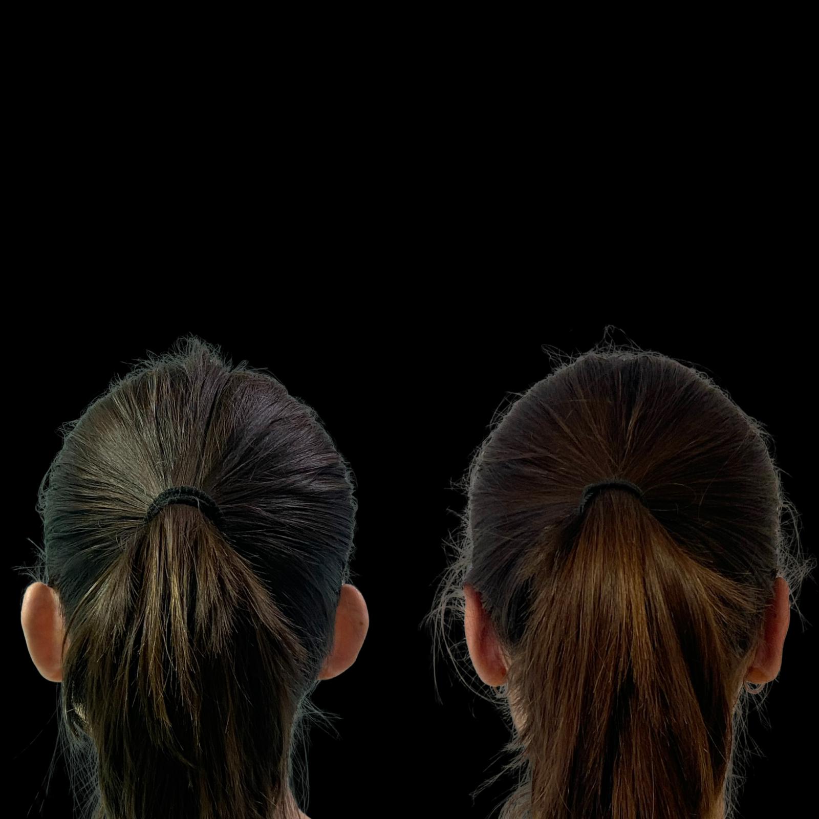 Otoplastia en Málaga – Cirugía estética para corregir orejas prominentes